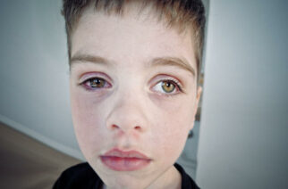 Trudny czas przed Antosiem. Jedno z oczu zostanie usunięte