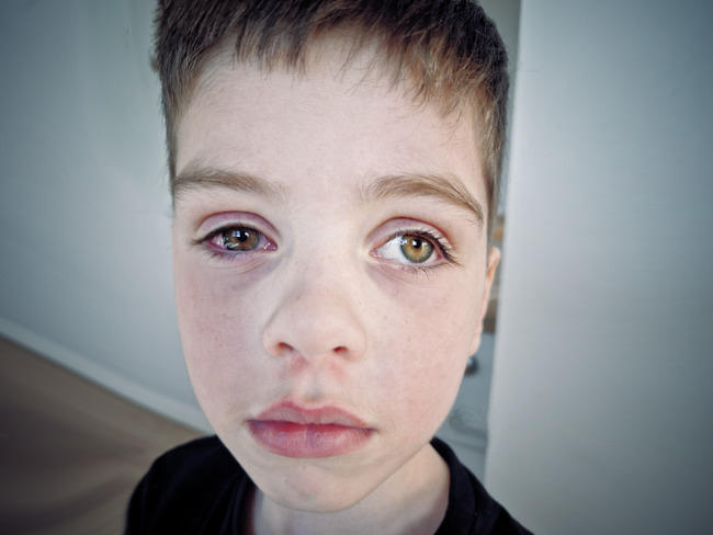 Trudny czas przed Antosiem. Jedno z oczu zostanie usunięte